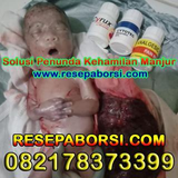 Cara Aborsi Penggugur kandungan