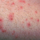 Nổi mẩn đỏ ở vùng kín nam giới