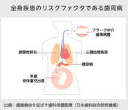 日本人成人の約80％以上が歯周病です。近年、歯周病を改善することで、多くの生活習慣病の予防になることが証明されています。